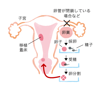 体外受精