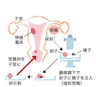 顕微授精