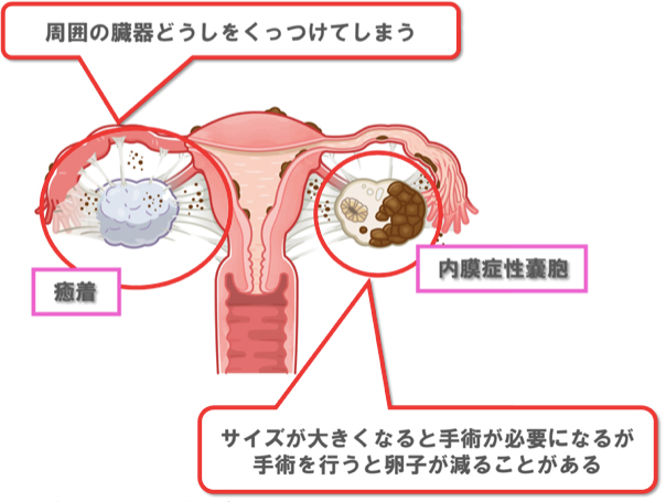 子宮内膜症と子宮筋腫