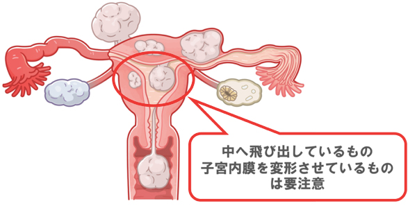 子宮筋腫